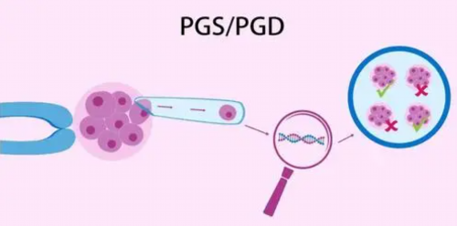盆腔囊肿能做试管吗？盆腔囊肿对做试管有什么影响？